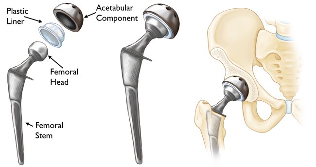 Hip Replacement Surgery Bangalore,India 